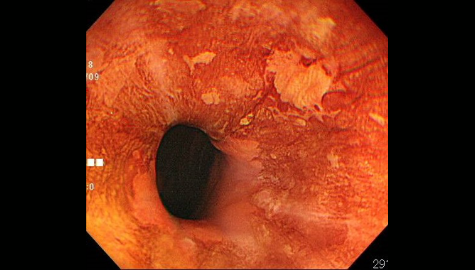 食道がんはルゴールと呼ばれる特殊染色をすると不染帯（白からピンク色に浮かび上がる）として認識されます