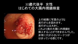 30歳代でも進行大腸がん