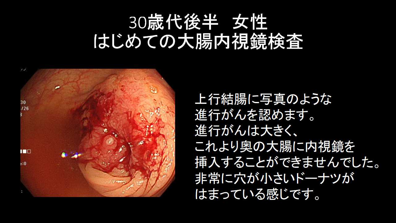 大腸内視鏡検査時の大腸