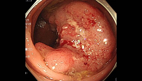 進行大腸がんの内視鏡画像