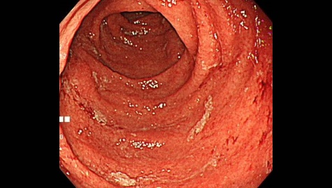 特殊な腸炎である潰瘍性大腸炎の内視鏡画像