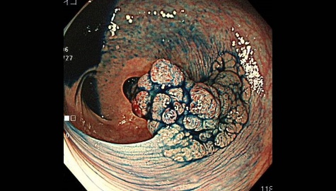 早期大腸がんの内視鏡画像