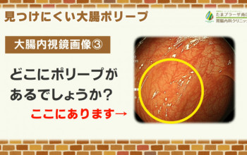 見つけにくい大腸ポリープ～ハイビジョン内視鏡での観察～