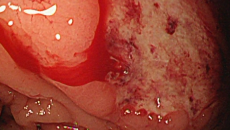 内視鏡治療後出血　緊急内視鏡で止血