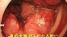 進行大腸がんになる前に……。