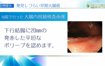 発見しづらい早期大腸がん