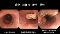 食道がんは早期発見が重要です。