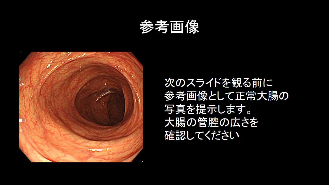正常な大腸