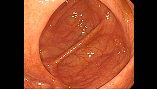 大腸内視鏡写真