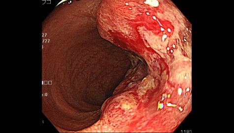 他臓器に転移しているような進行大腸がん