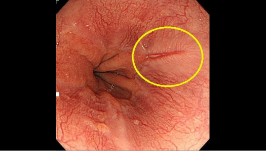 逆流性食道炎の内視鏡画像