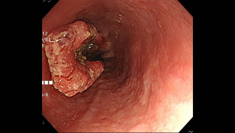 進行食道がんの内視鏡画像