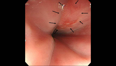 進行食道がんの内視鏡画像