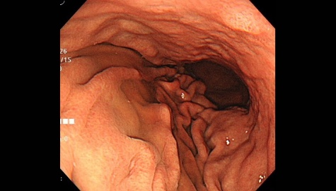 胃が十分に膨らまず、ヒダとヒダの間がきちんと観察できないまま検査が終わってしまいます