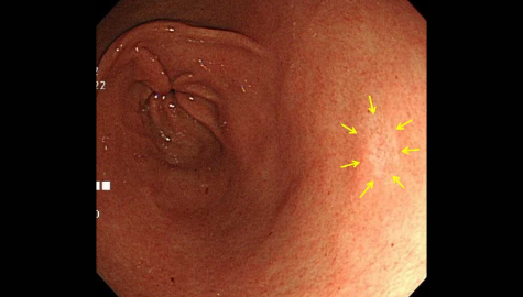 早期胃がんの内視鏡画像
