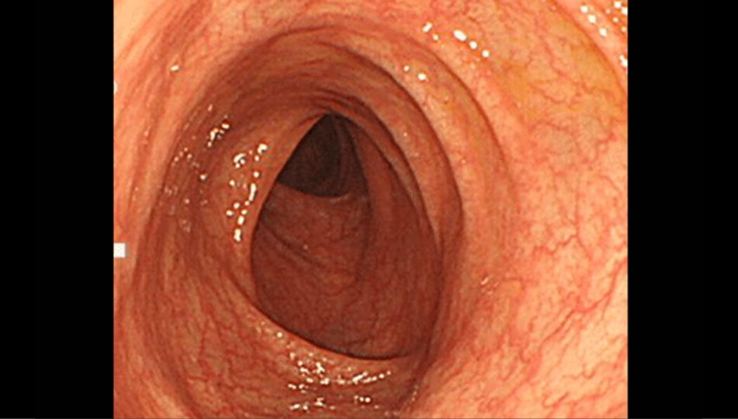 血管が透けて見えるとてもきれいな大腸粘膜