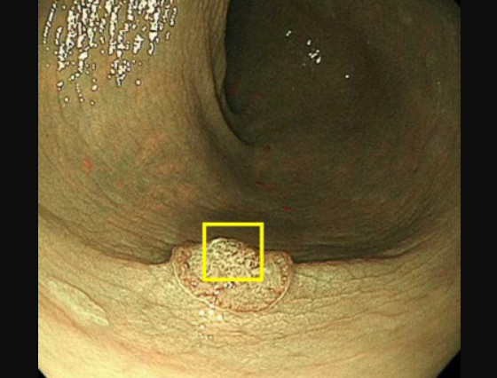 NBIでの早期大腸がんの内視鏡像