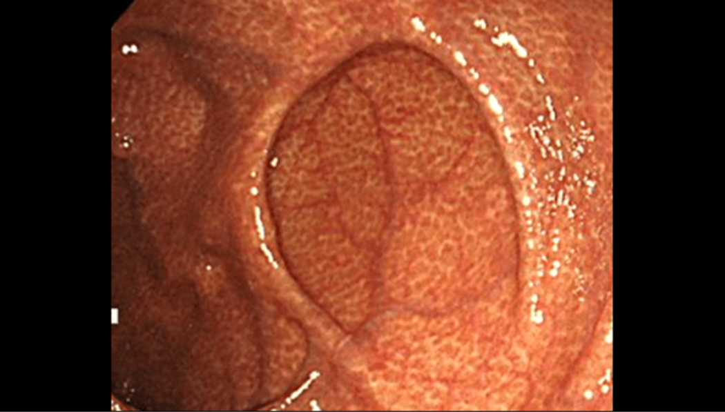 刺激性下剤を長期間連用して、大腸の粘膜が真っ黒に色素沈着した様子