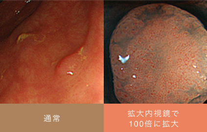 見つかりにくい小さめの大腸ポリープ