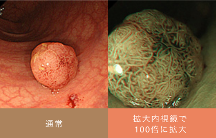 比較的大きめの大腸ポリープ