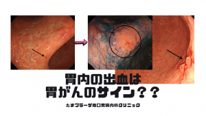 胃内の出血は要注意‼