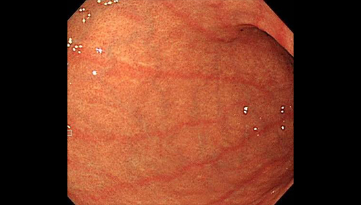 ストレス胃炎の内視鏡画像