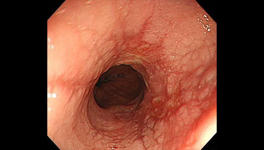 逆流性食道炎の内視鏡画像