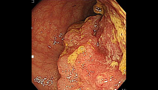 進行大腸がん