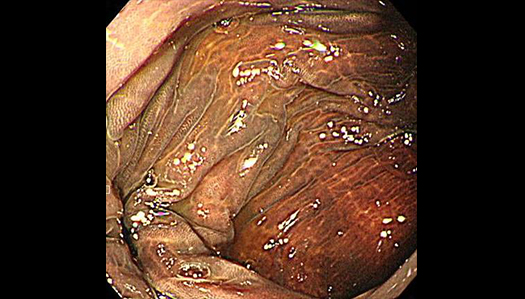 長年の刺激性下剤の服用で腸は真っ黒