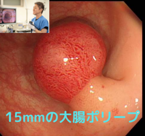 大腸CT検査と大腸内視鏡検査の比較！