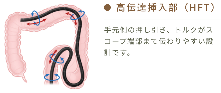 高伝達挿入部（HFT）のイメージ図