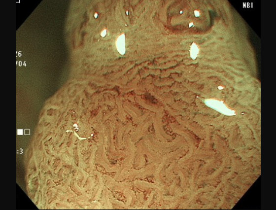 NBI100倍拡大内視鏡画像
