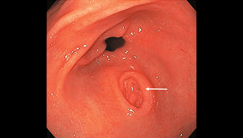 幽門前庭部に見られた胃憩室