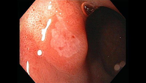 ピロリ菌感染に起因した十二指腸潰瘍の治癒期の内視鏡写真