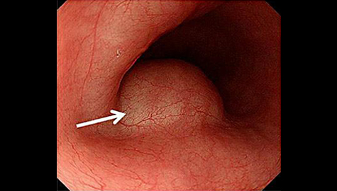 粘膜下腫瘍で食道の内腔を半分近く占拠