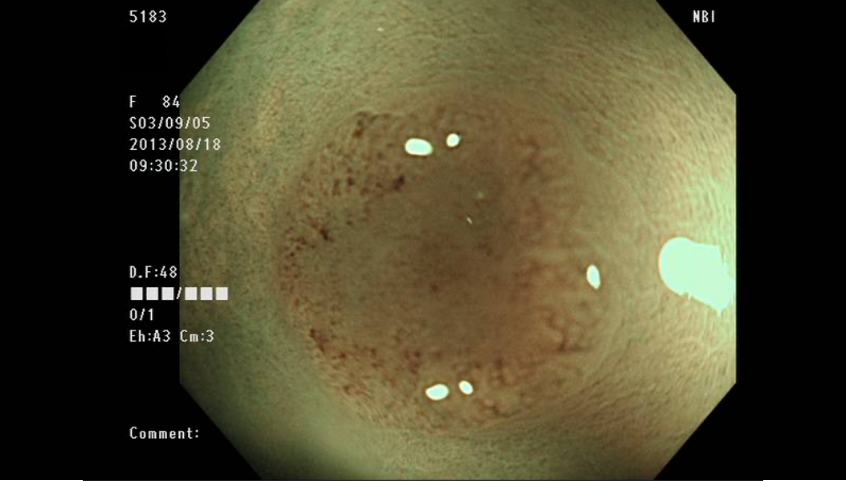 NBI（狭帯域光観察）でのデュアルフォーカス拡大内視鏡画像