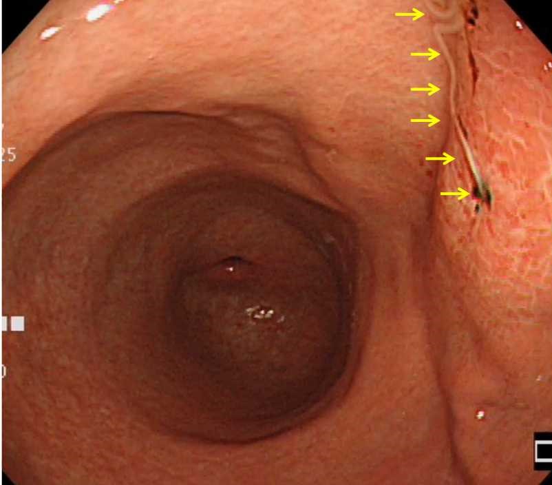 胃内にアニサキスを認めます。