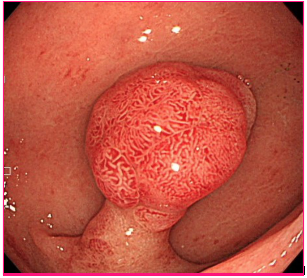 隆起型ポリープ
