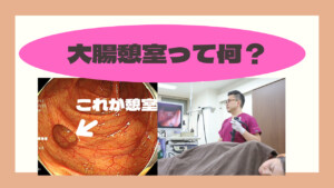 大腸憩室って何？