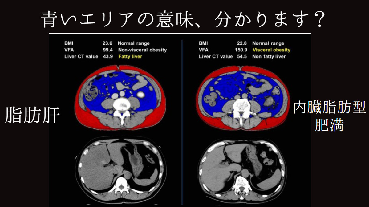 内臓脂肪型肥満は逆流性食道炎の危険因子 たまプラーザ南口胃腸内科クリニック 消化器内視鏡横浜青葉区院 内臓脂肪型肥満は逆流性食道炎の危険因子 たまプラーザ南口胃腸内科クリニック 消化器内視鏡横浜青葉区院