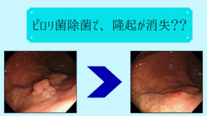 ピロリ除菌の効果（腺腫）