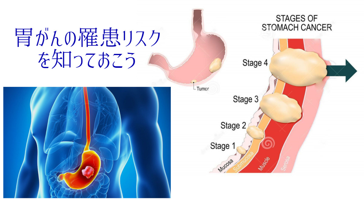 ピロリ菌感染で胃がんリスクはどのくらい上がる？？