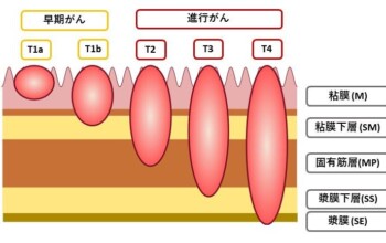 慢性胃炎って胃がんの原因なのですか？