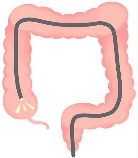 大腸内視鏡検査のイラスト