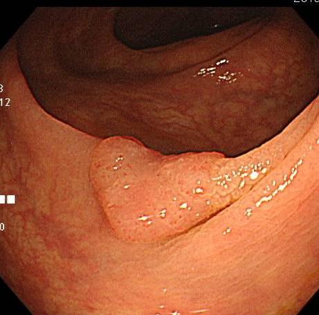 大腸腺腫の内視鏡写真です。この段階で切除することで大腸がんの予防ができます。