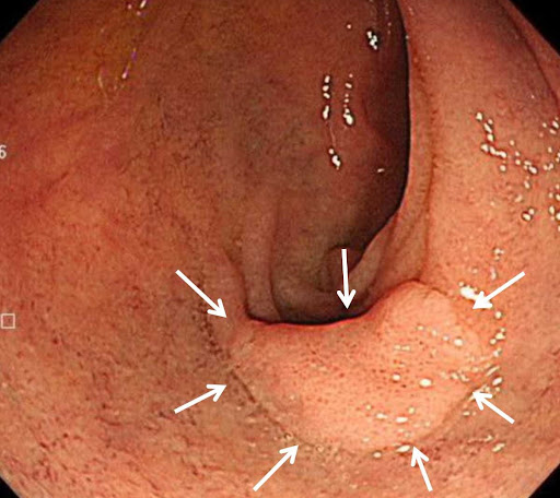 十二指腸腺腫の写真