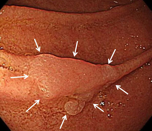 十二指腸腺腫の写真