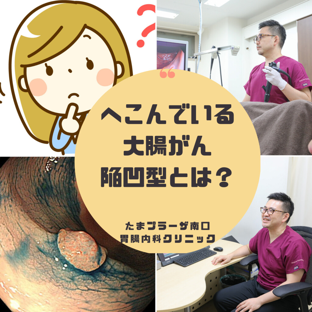 へこんでいるタイプの大腸がん　陥凹型とは？