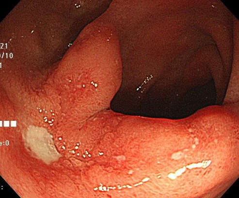 十二指腸潰瘍の内視鏡写真