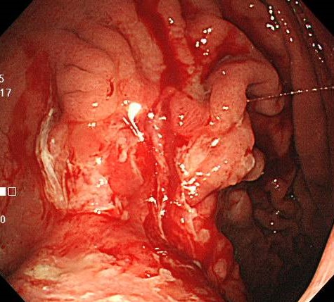 進行胃がんの内視鏡写真
